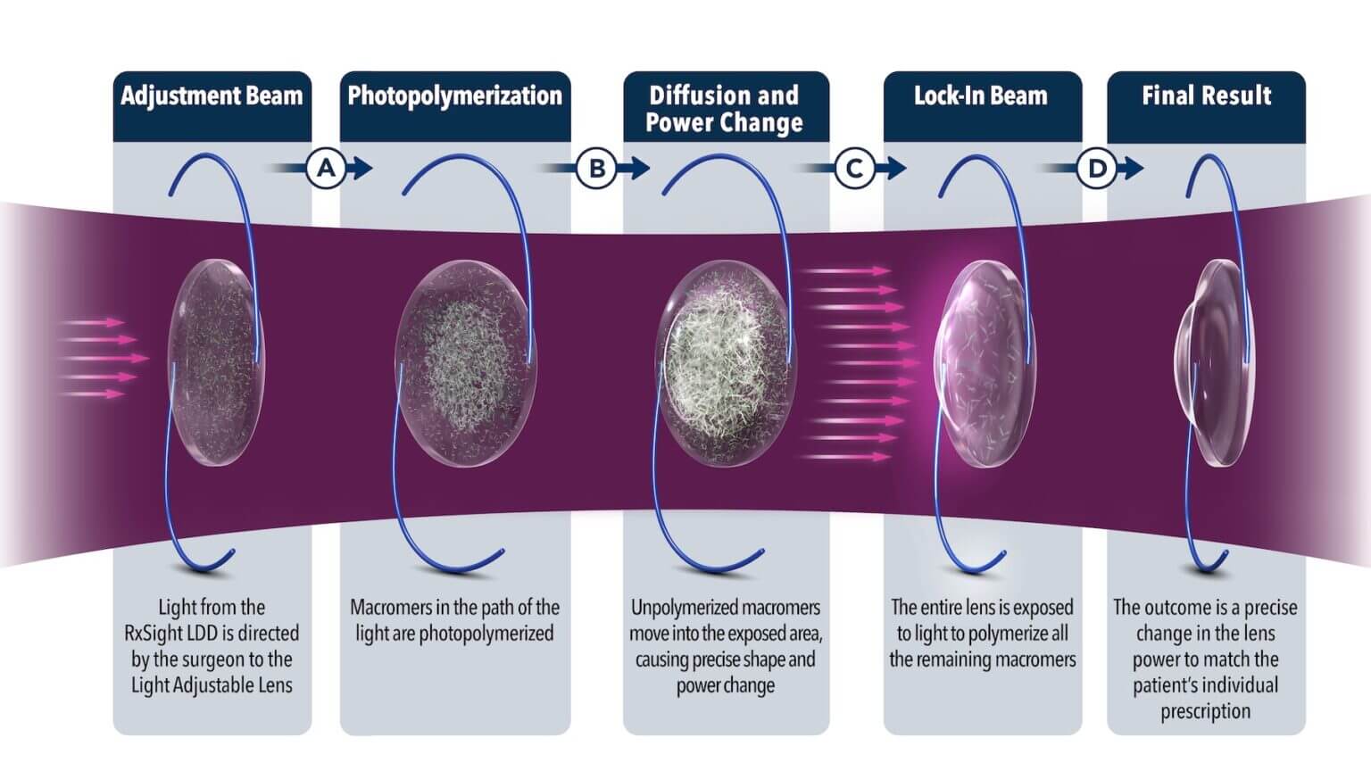 1 - Light from the R×Sight LDD is directed by the surgeon to the Light Adjustable Lens. 2- Macromers in the path of the light are photopolvmerized. 3- Unpolymerized macromers move into the exposed area, causing precise shape and power change. 4- The entire lens is exposed to light to polvmerize all the remaining macromers. 5- The outcome is a precise change in the lens power to match the patient's individual prescription.